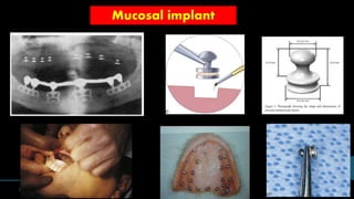 Mucosal implant
 