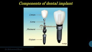 Components of dental implant
 