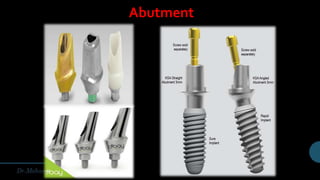 Abutment
 
