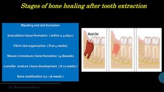Stages of bone healing after tooth extraction
Bleeding and clot formation
Granulation tissue formation ( within 2-3 days )
Fibrin clot organization ( first 4 weeks)
Woven ( immature ) bone formation (4-8)weeks
Lamellar (mature ) bone development ( 8-12 weeks )
Bone stabilization (12 -16 weeks )
 