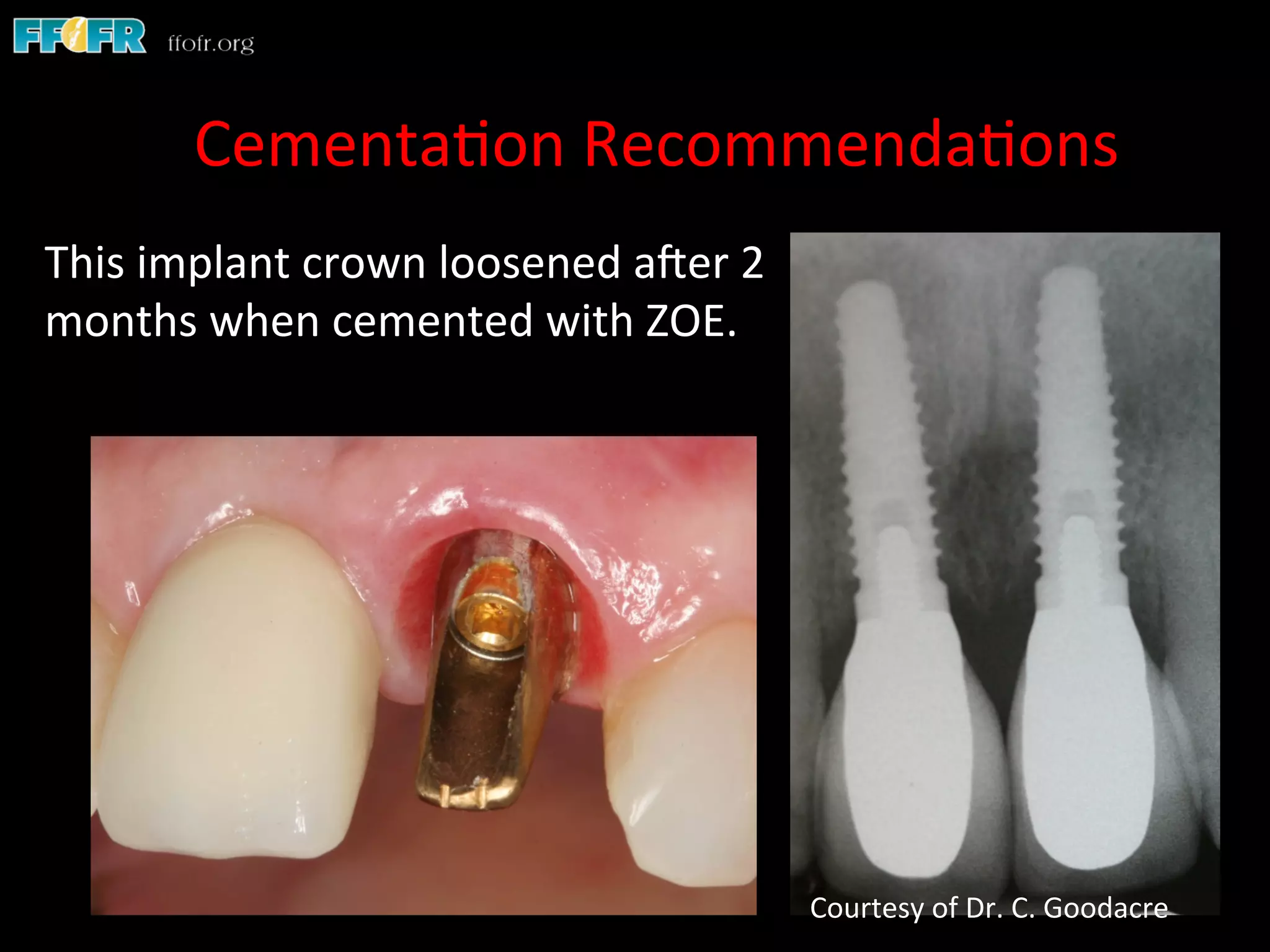 Screw Retention Feature Dental implants cement retention vs screw retention | PDF
