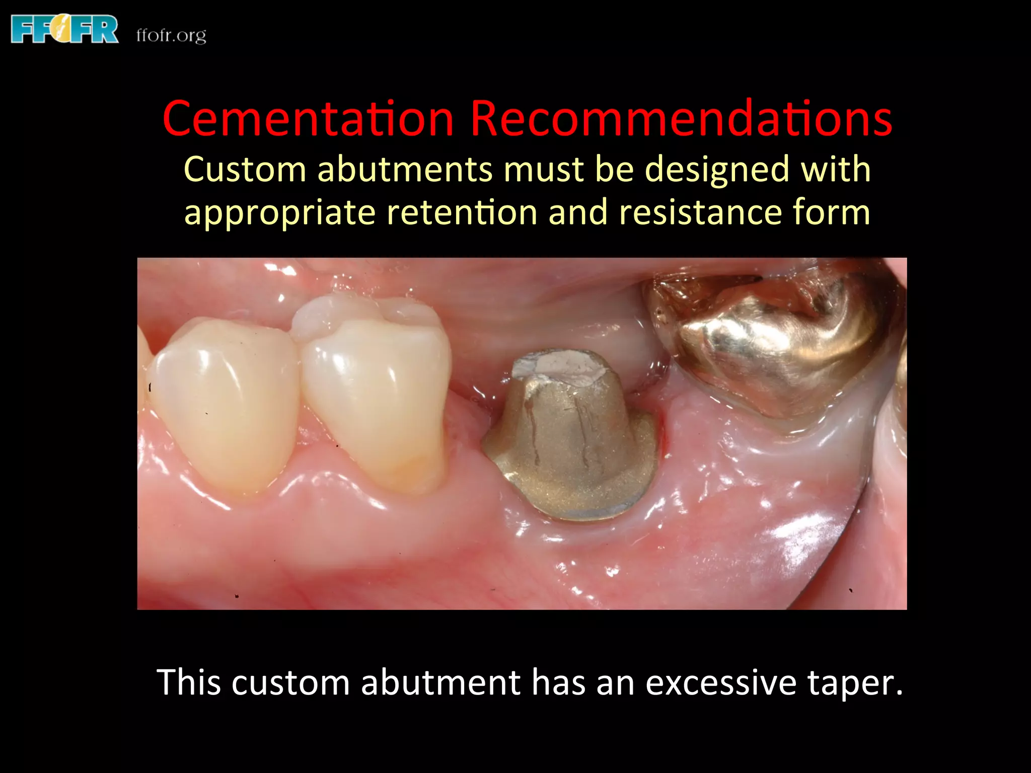 Screw Retention Feature Dental implants cement retention vs screw retention | PDF