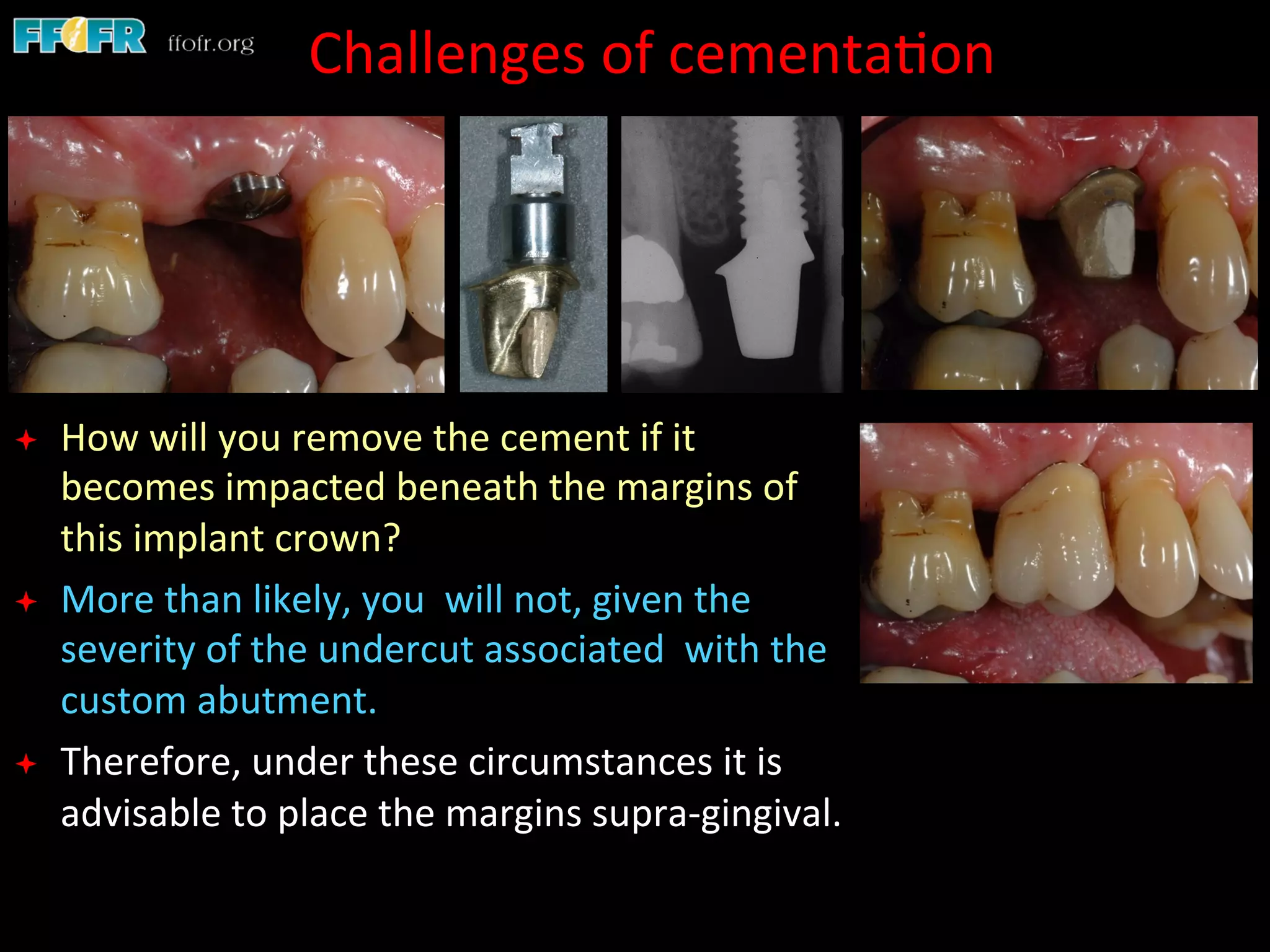 Screw Retention Feature Dental implants cement retention vs screw retention | PDF