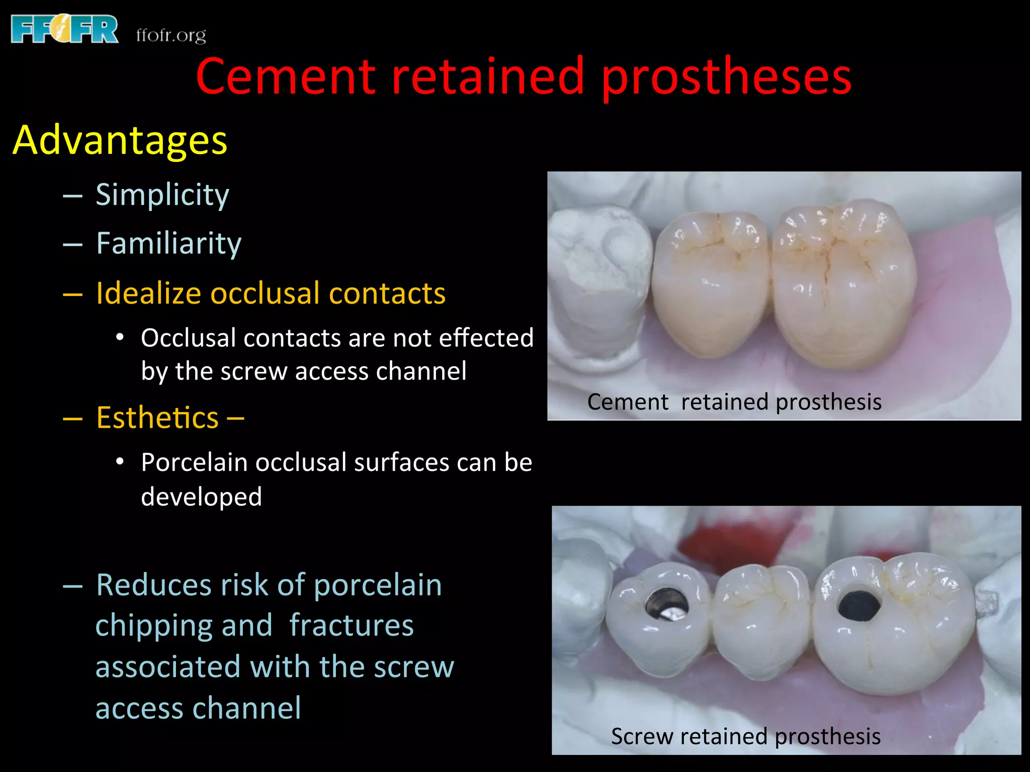 Screw Retention Feature Dental implants cement retention vs screw retention | PDF