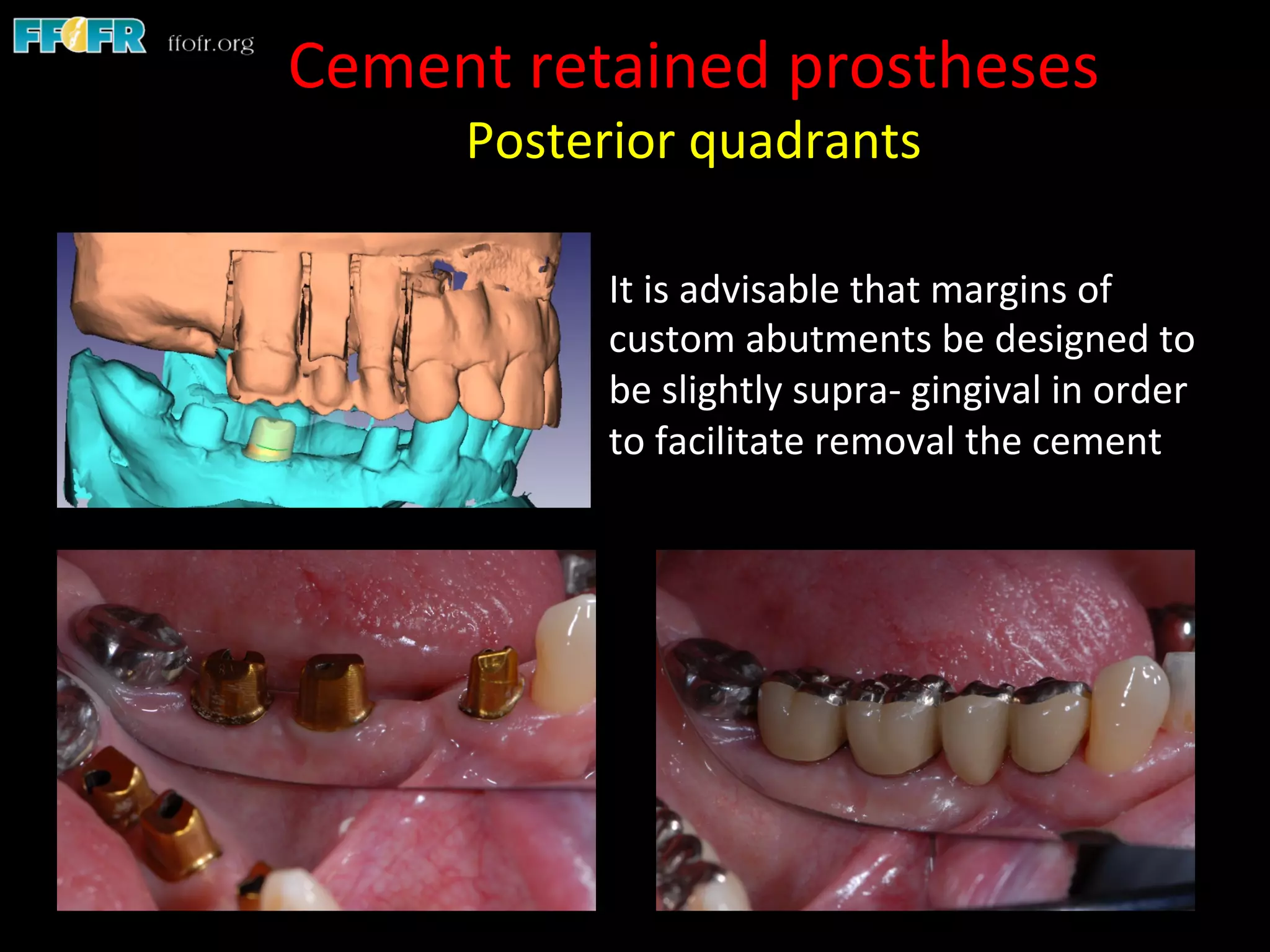 Screw Retention Feature Dental implants cement retention vs screw retention | PDF