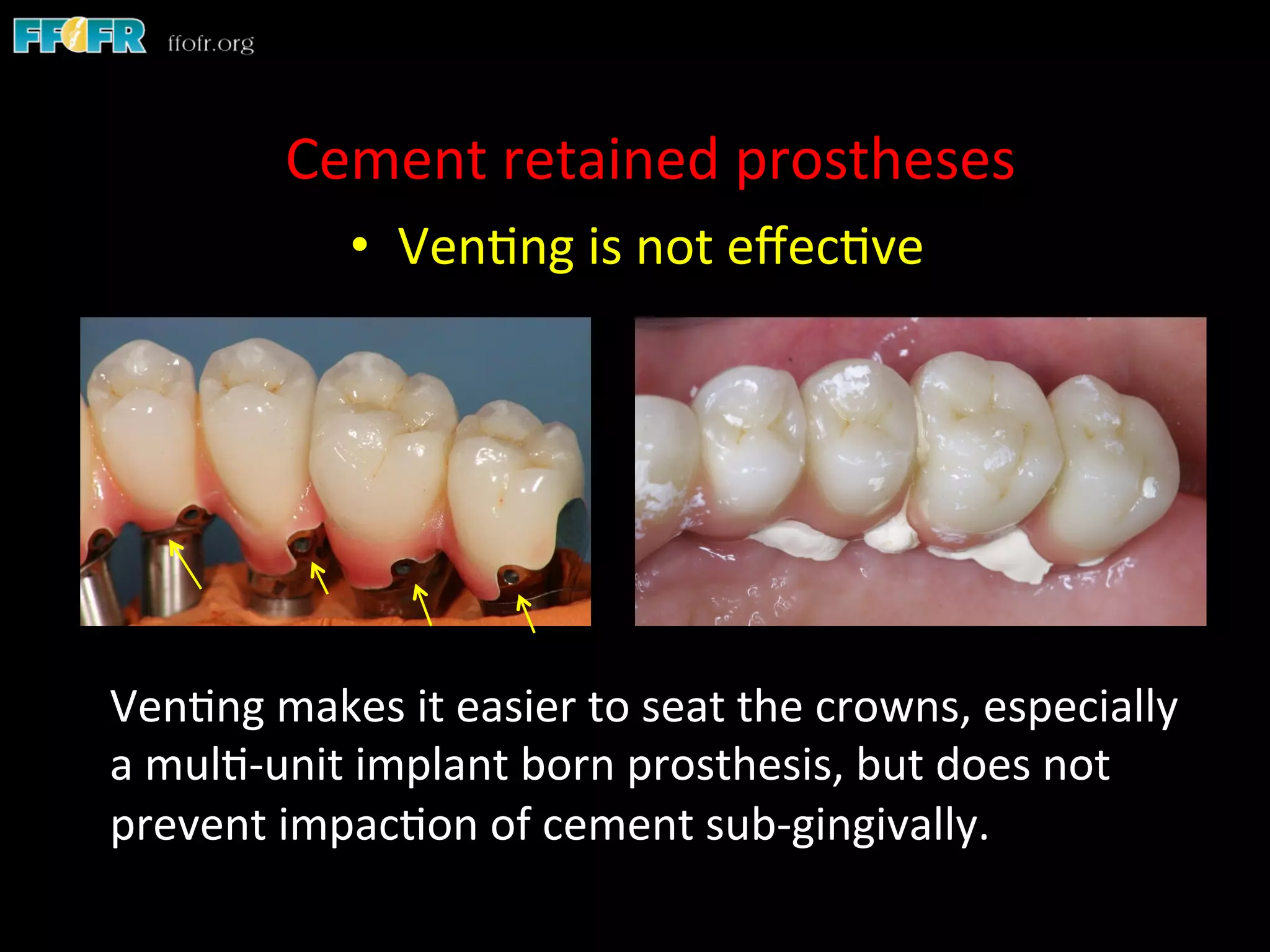 Screw Retention Feature Dental implants cement retention vs screw retention | PDF