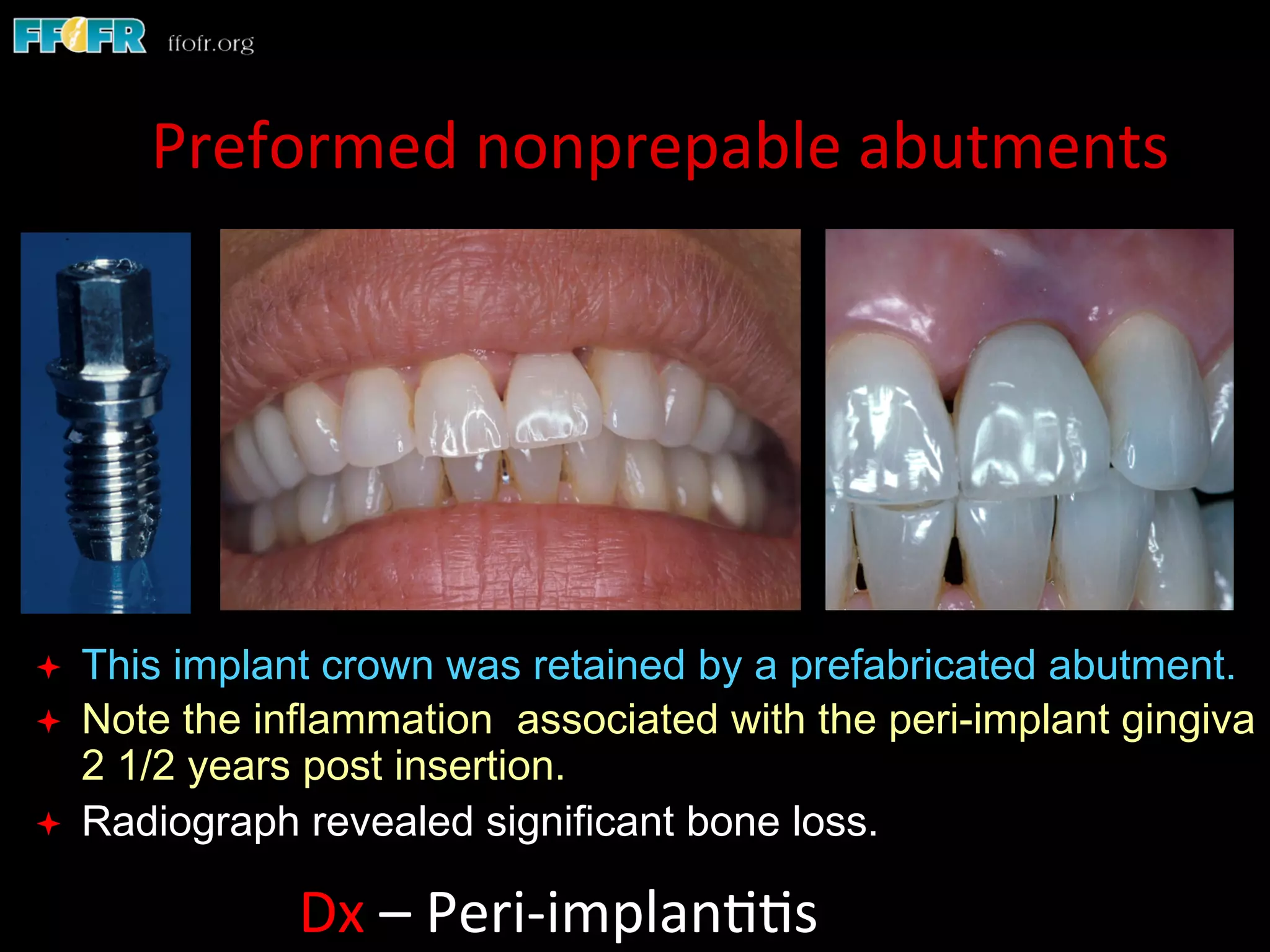 Screw Retention Feature Dental implants cement retention vs screw retention | PDF