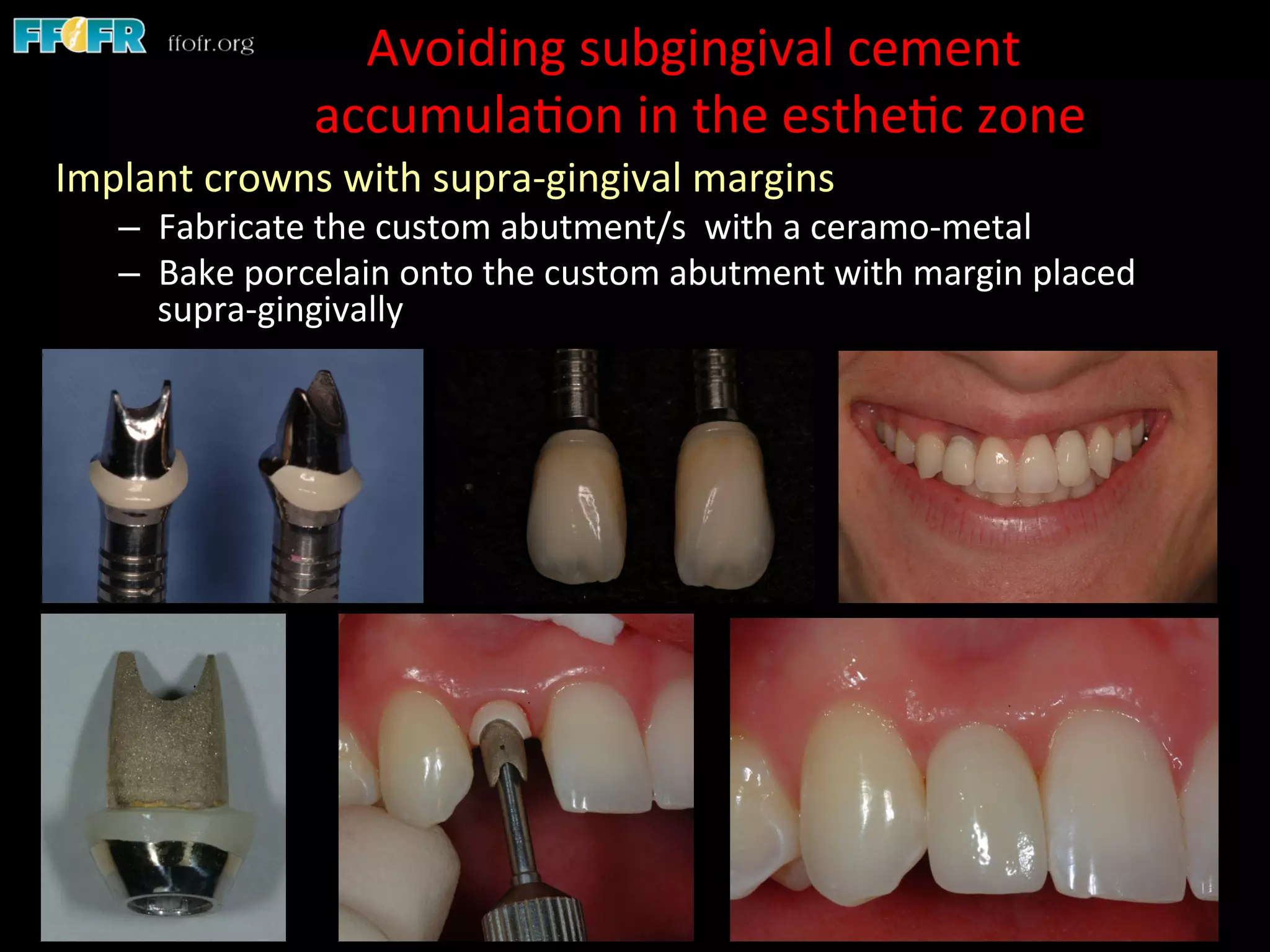 Dental implants cement retention vs screw retention PPT
