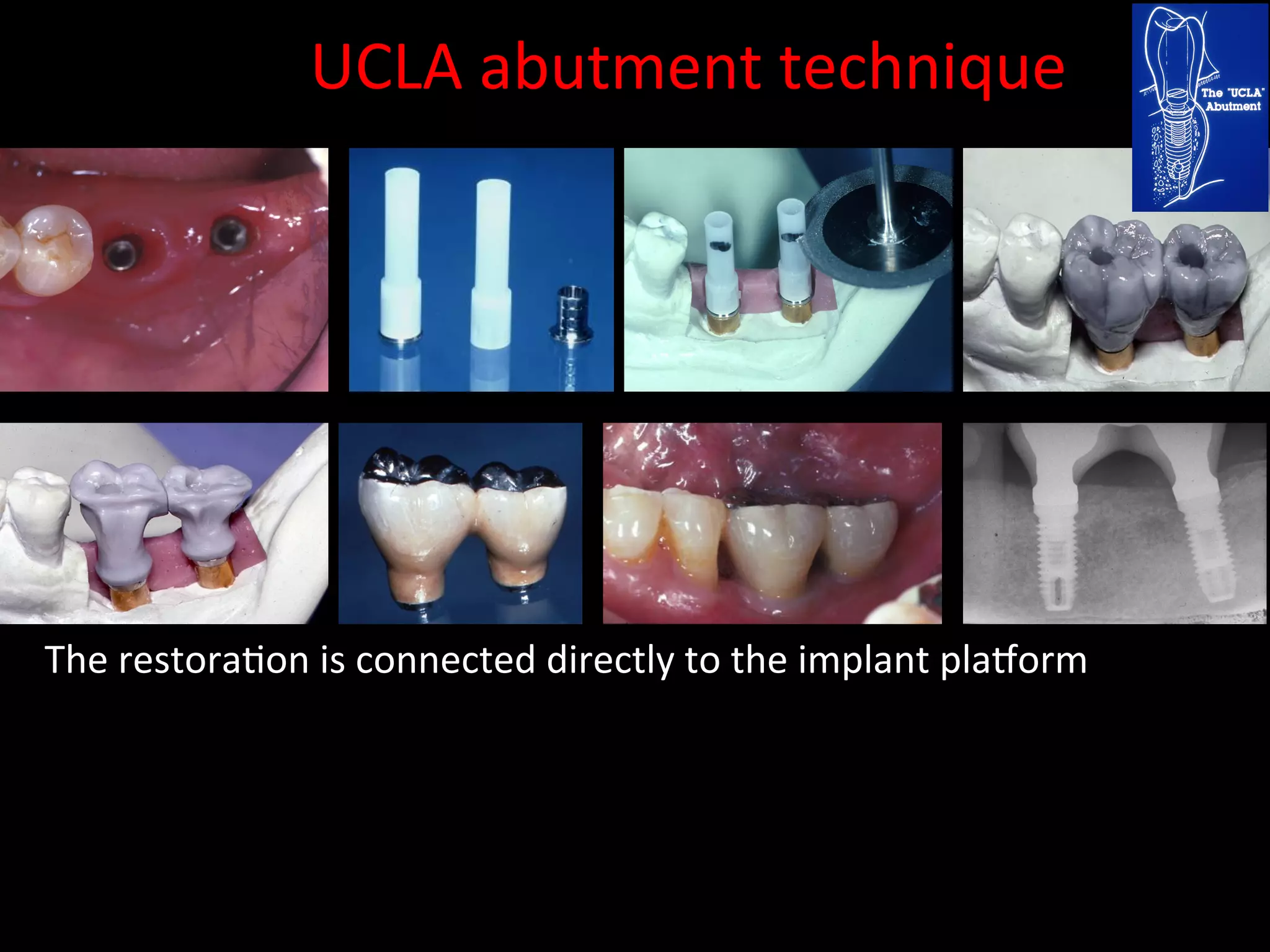 Screw Retention Feature Dental implants cement retention vs screw retention | PDF