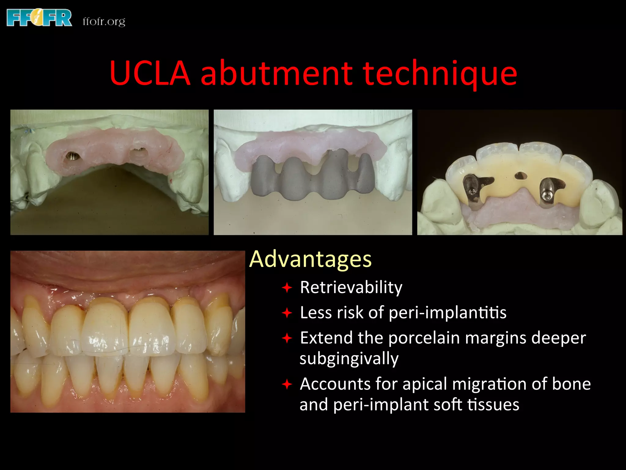 Dental implants cement retention vs screw retention PPT