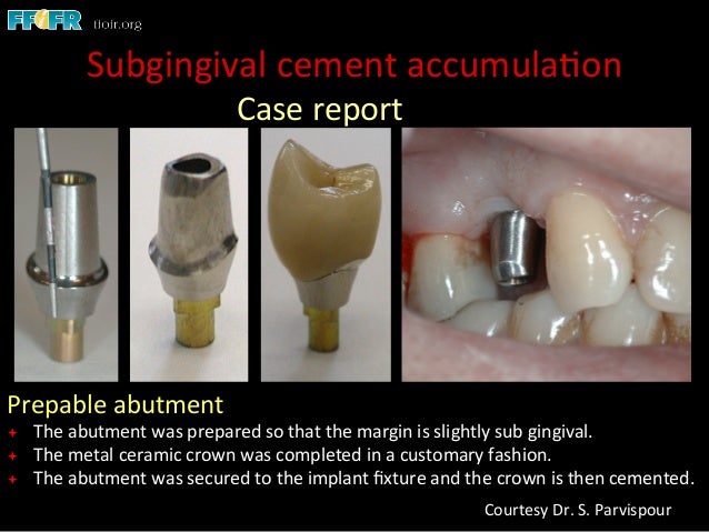implants abutment
