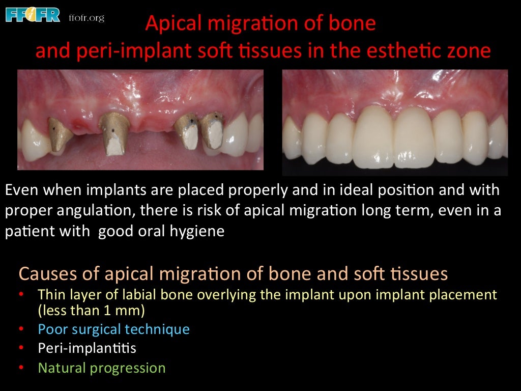 Dental implants cement retention vs screw retention