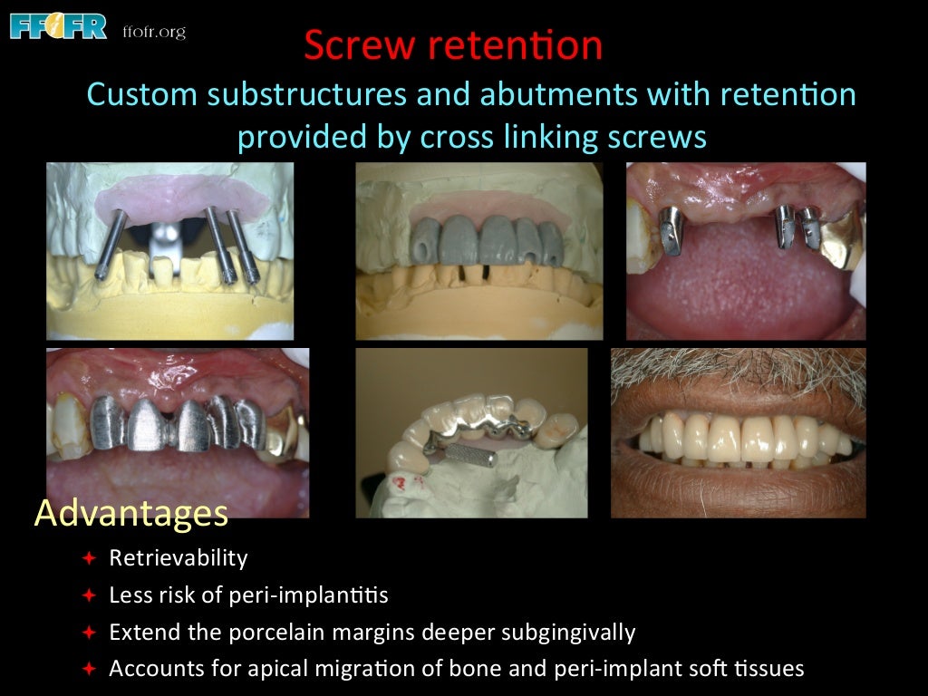 Dental implants cement retention vs screw retention