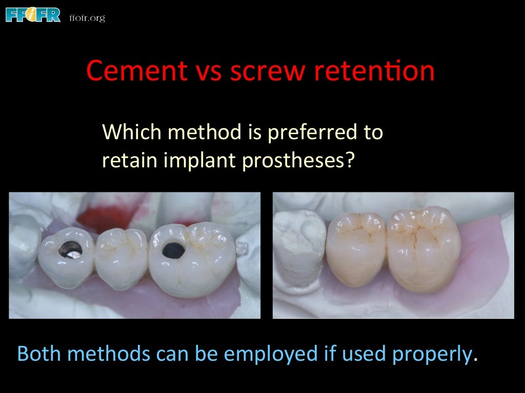 Dental implants cement retention vs screw retention