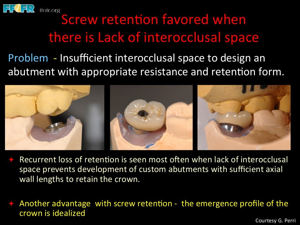 Dental implants cement retention vs screw retention