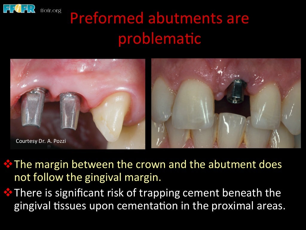 Dental implants cement retention vs screw retention