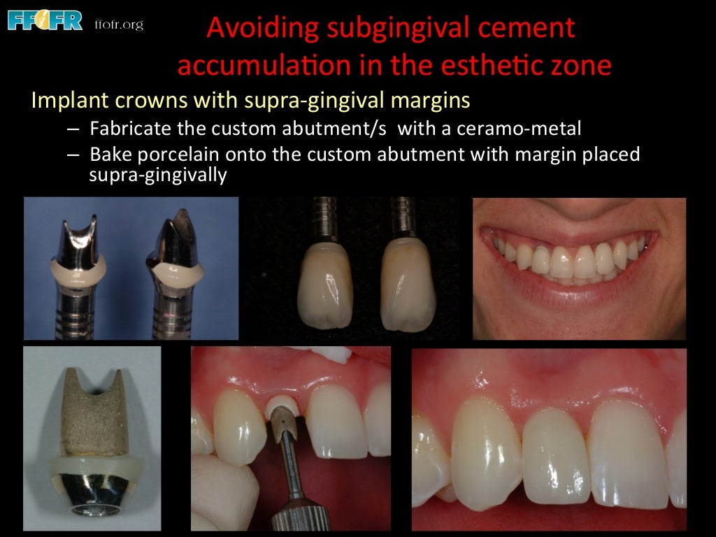 Dental implants cement retention vs screw retention