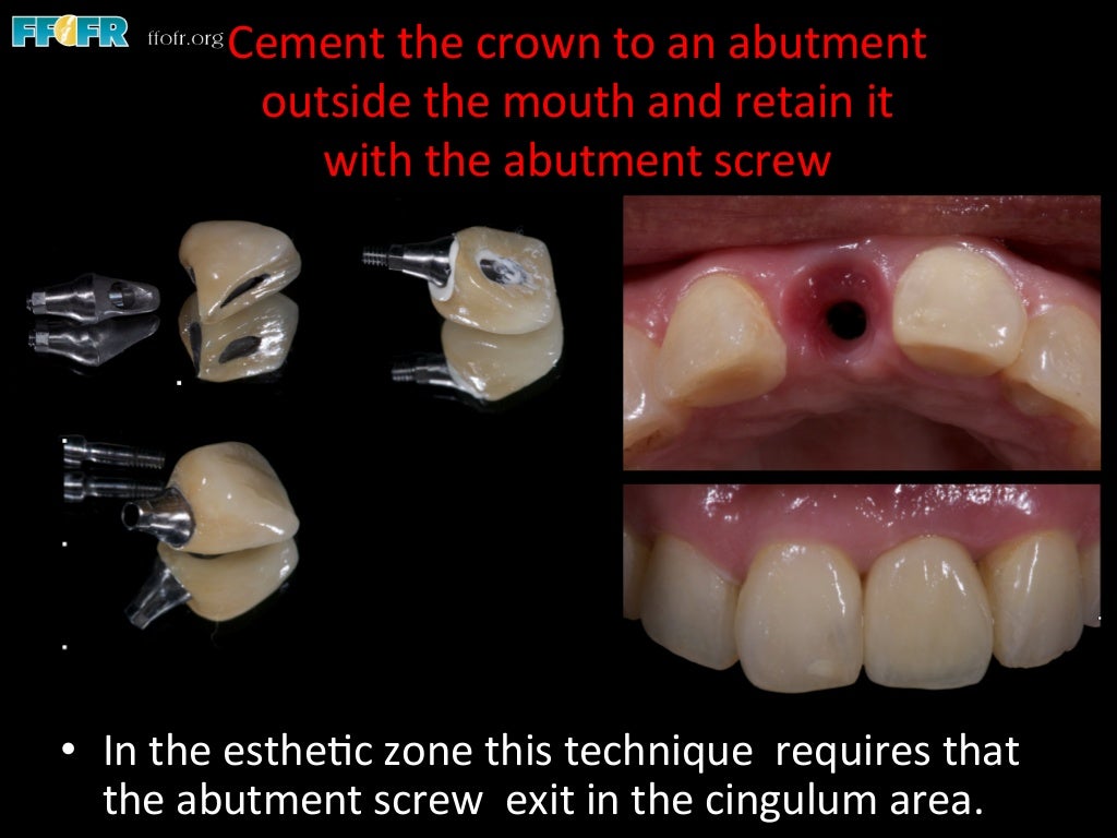 Dental implants cement retention vs screw retention