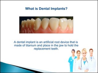 What is Dental Implants?
A dental implant is an artificial root device that is
made of titanium and place in the jaw to hold the
replacement teeth.
 