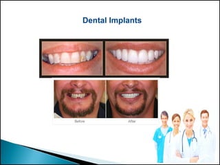 Dental Implants
 
