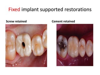 Fixed implant supported restorations
Screw retained Cement retained
 