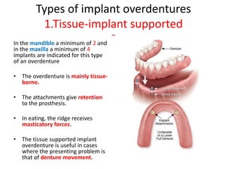 Types of implant overdentures
1.Tissue-implant supported
–
In the mandible a minimum of 2 and
in the maxilla a minimum of 4
implants are indicated for this type
of an overdenture
• The overdenture is mainly tissue-
borne.
• The attachments give retention
to the prosthesis.
• In eating, the ridge receives
masticatory forces.
• The tissue supported implant
overdenture is useful in cases
where the presenting problem is
that of denture movement.
 