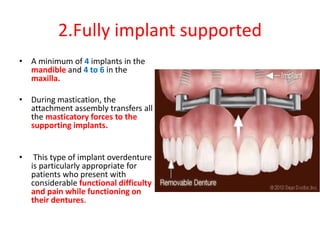 2.Fully implant supported
• A minimum of 4 implants in the
mandible and 4 to 6 in the
maxilla.
• During mastication, the
attachment assembly transfers all
the masticatory forces to the
supporting implants.
• This type of implant overdenture
is particularly appropriate for
patients who present with
considerable functional difficulty
and pain while functioning on
their dentures.
 