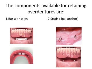 The components available for retaining
overdentures are:
1.Bar with clips 2.Studs ( ball anchor)
 