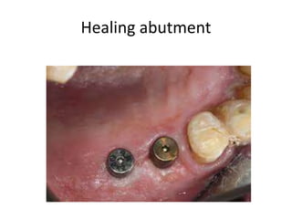 Healing abutment
 
