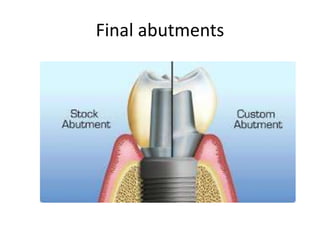 Final abutments
 