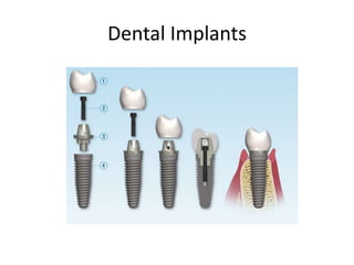 Dental Implants
 