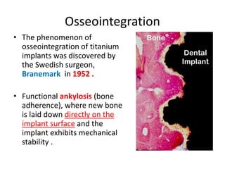 Osseointegration
• The phenomenon of
osseointegration of titanium
implants was discovered by
the Swedish surgeon,
Branemark in 1952 .
• Functional ankylosis (bone
adherence), where new bone
is laid down directly on the
implant surface and the
implant exhibits mechanical
stability .
 
