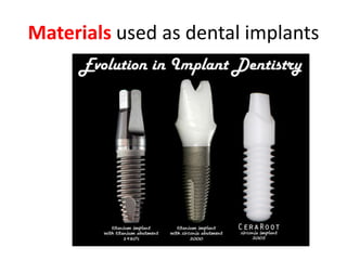 Materials used as dental implants
 