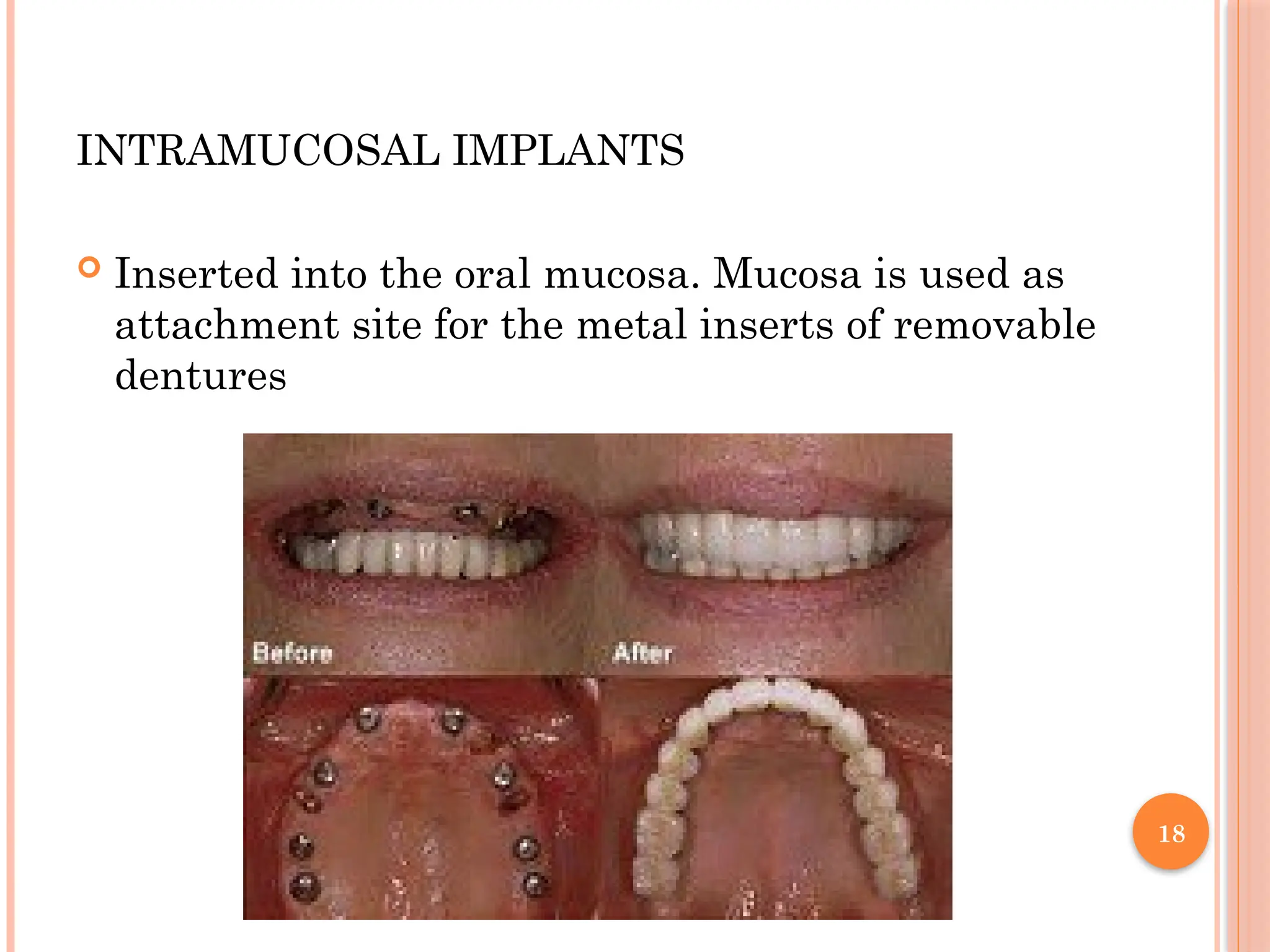 18
INTRAMUCOSAL IMPLANTS
 Inserted into the oral mucosa. Mucosa is used as
attachment site for the metal inserts of removable
dentures
 