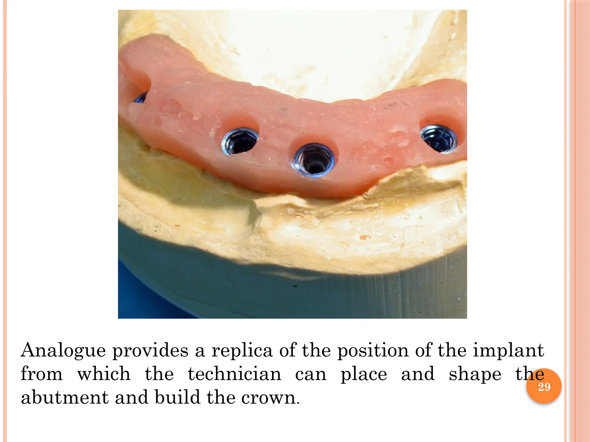 29
Analogue provides a replica of the position of the implant
from which the technician can place and shape the
abutment and build the crown.
 