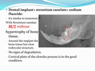Dental Implants and Osteoporosis | PPTX
