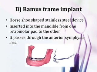 B) Ramus frame implant
• Horse shoe shaped stainless steel device
• Inserted into the mandible from one
retromolar pad to the other
• It passes through the anterior symphysis
area
 