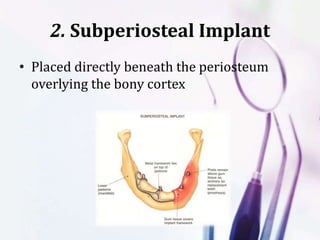 2. Subperiosteal Implant
• Placed directly beneath the periosteum
overlying the bony cortex
 