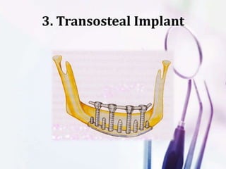 3. Transosteal Implant
 