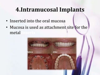 4.Intramucosal Implants
• Inserted into the oral mucosa
• Mucosa is used as attachment site for the
metal inserts
 