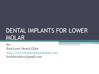 DENTAL IMPLANTS FOR LOWER
MOLAR
By-
Best Laser Dental Clinic
http://www.bestlaserdentalclinic.com
bestdentalno1@gmail.com
 