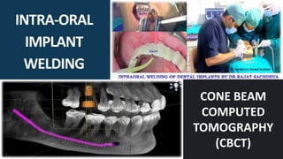 INTRA-ORAL
IMPLANT
WELDING
CONE BEAM
COMPUTED
TOMOGRAPHY
(CBCT)
 