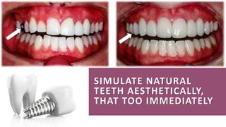 SIMULATE NATURAL
TEETH AESTHETICALLY,
THAT TOO IMMEDIATELY
 