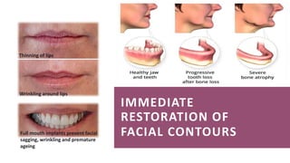IMMEDIATE
RESTORATION OF
FACIAL CONTOURS
Wrinkling around lips
Thinning of lips
Full mouth implants prevent facial
sagging, wrinkling and premature
ageing
 