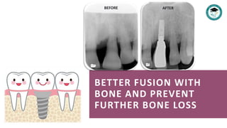 BETTER FUSION WITH
BONE AND PREVENT
FURTHER BONE LOSS
BEFORE AFTER
 
