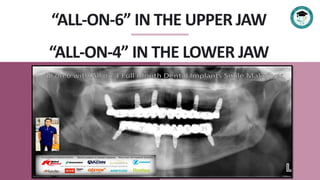 “ALL-ON-6” IN THE UPPER JAW
“ALL-ON-4” IN THE LOWER JAW
 