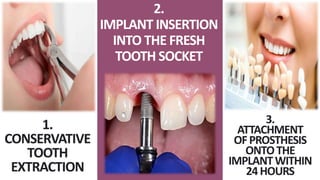 2.
IMPLANT INSERTION
INTO THE FRESH
TOOTH SOCKET
1.
CONSERVATIVE
TOOTH
EXTRACTION
3.
ATTACHMENT
OFPROSTHESIS
ONTOTHE
IMPLANTWITHIN
24HOURS
 