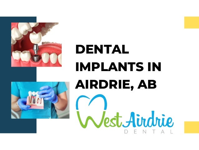 DENTAL
IMPLANTS IN
AIRDRIE, AB
 