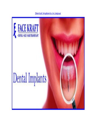 Dental Implants in Jaipur
 
