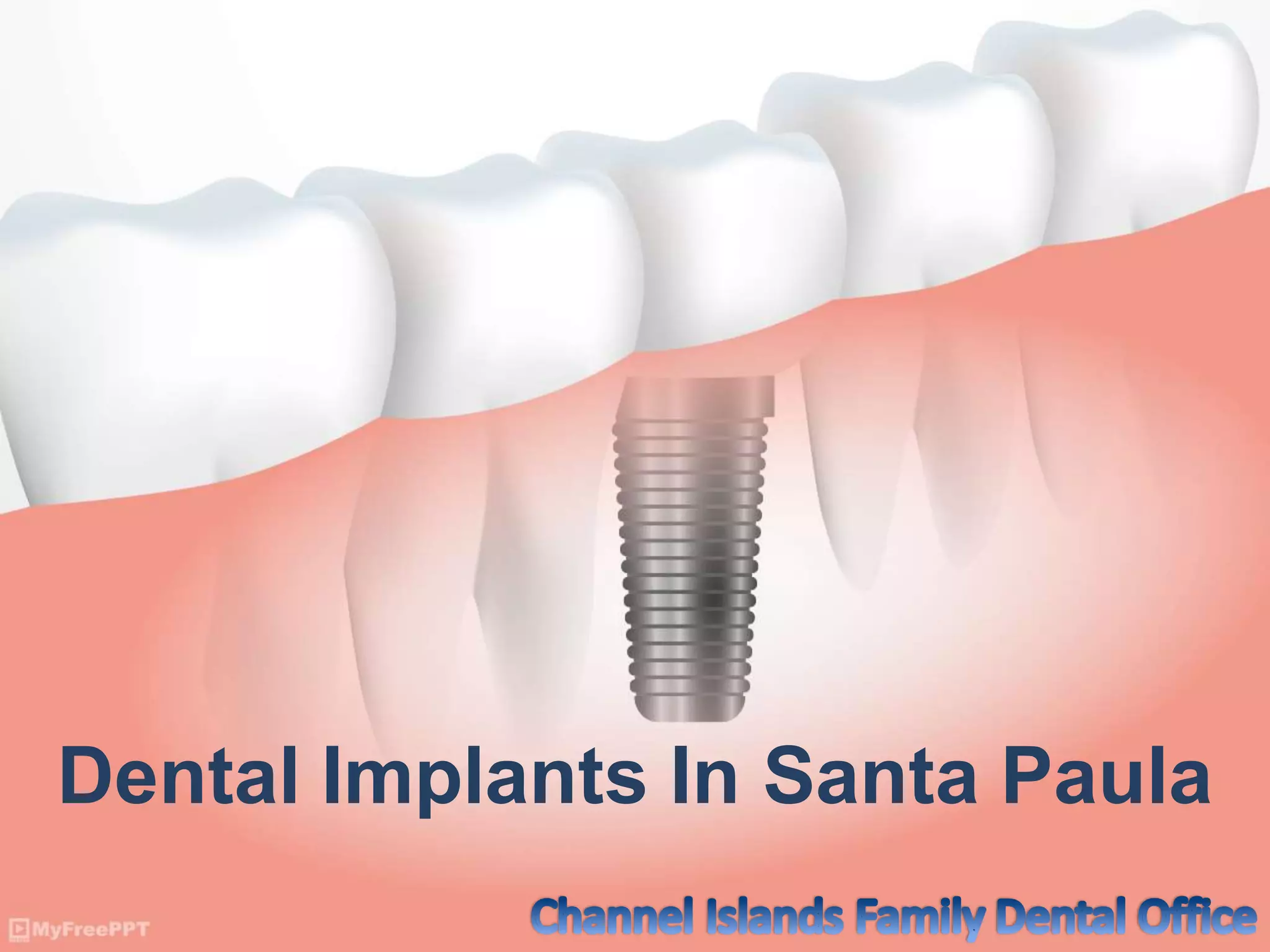 Dental Implants In Santa Paula PPT
